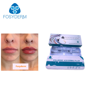 1ml Hyaluronic όξινο δερμικό υλικό πληρώσεως Fosyderm εγχύσεων για το χείλι