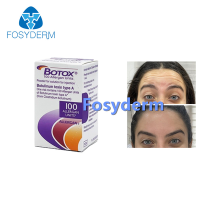 100Units Allergan Botulinum Toxion για αφαιρούν τον του προσώπου τύπο Α Botox ρυτίδων