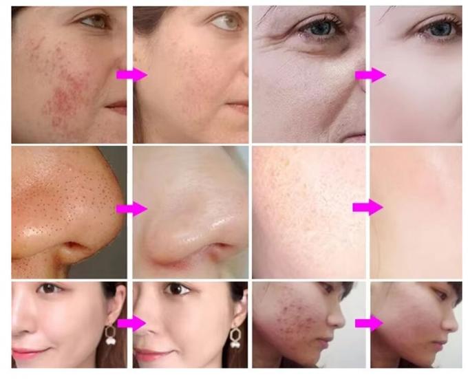 Hydra Peeling Hydra Small Bubble Water Hydro Aqua Facial H2o2 Hydra Μηχανή 2