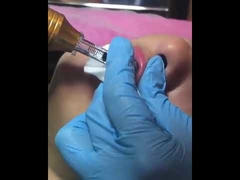 Μάνδρα Hyaluron