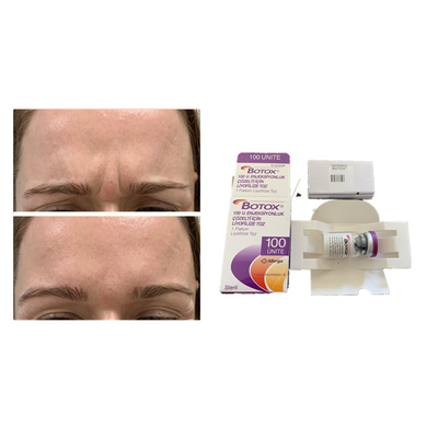 Άσπρη Allergan Botulinum έγχυση γήρανσης  τοξινών αντι