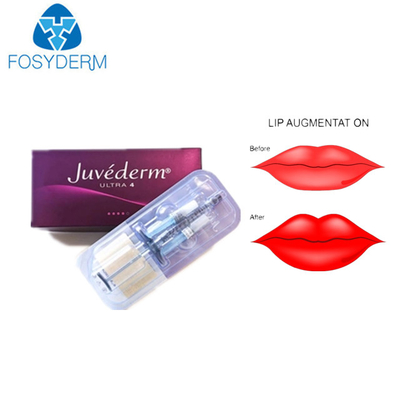 Hyaluronic όξινο δερμικό υλικό πληρώσεως εξαιρετικά 3 Juvederm για τα χείλια προσώπου
