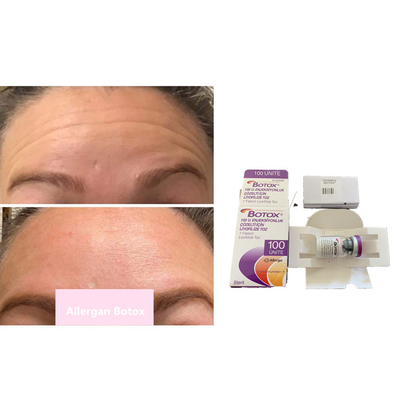 Botulinum τύπος Α τοξινών s 100iu Allergan για τις αντι ρυτίδες