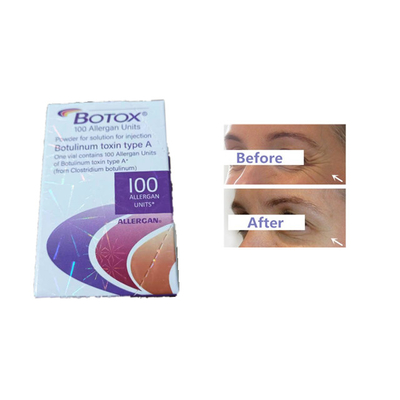 Botulinum τοξίνη εγχύσεων Botox Allergan 100 ρυτίδες μετώπων μονάδων