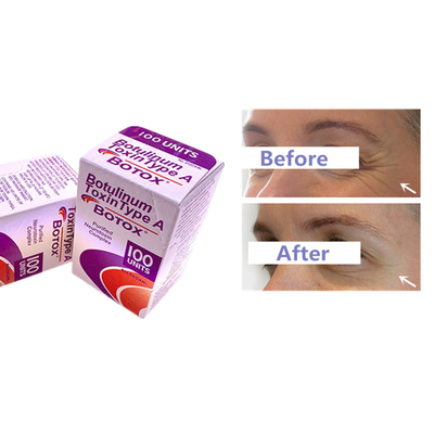 Η Botulinum έγχυση Allergan  τοξινών για τη ρυτίδα αφαιρεί