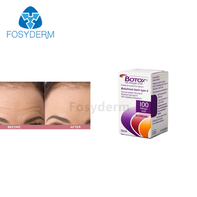 100 Allergan  Botulinum μονάδες εγχύσεων τοξινών για τις αντι ρυτίδες