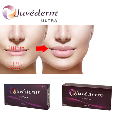 Juvederm Ultra3 Υαλουρονικό οξύ για χείλη Δερμική ένεση με τζελ προγεμισμένο