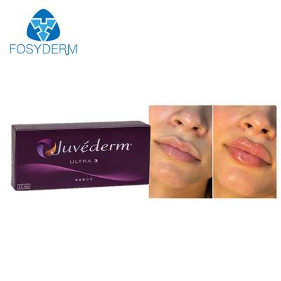 Juvederm Dermal Lip Fillers 2*1 ml Χυαλουρονικό οξύ