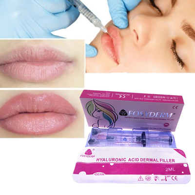 Φόλυμα χείλη Διεύρυνση πληρότητας των χείλων 2 ml Dermal Filler Fosyderm HA Filler Injection