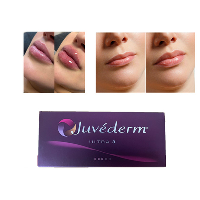 Το Juvederm Hyaluronic Acid Dermal Filler Anti Wrinkles (Προστασία κατά των ρυτίδων)