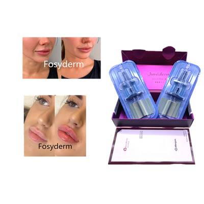 Το Juvederm Hyaluronic Acid Dermal Filler Anti Aging 2*1ml Φαγικό Φαγικό