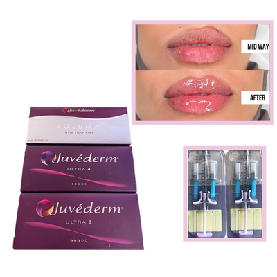Juvederm Voluma Ultra3 Ultra4 HA Gel Fillers 2 ml Υαλουρονικό οξύ