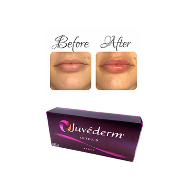 Juvederm Ενέσιμο δερματικό γέμισμα υαλουρονικού οξέος