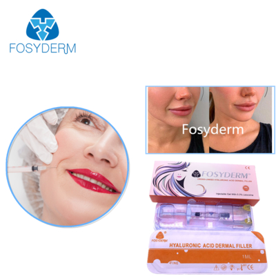 Υαλουρονικό οξύ δερματικό γεμιστήρα 24mg/ml για το πρόσωπο χείλη μάγουλο πηγούνι