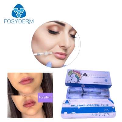 Υαλουρονικό οξύ δερματικό γεμιστήρα 24mg/ml για το πρόσωπο χείλη μάγουλο πηγούνι