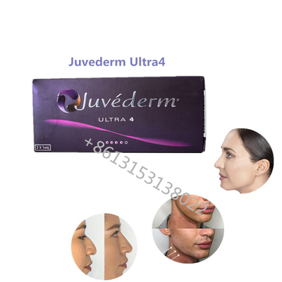 Δερμικά υλικά πληρώσεως Juvederm εκτάριο υλικών πληρώσεως Juvederm Ultra4 Allergan χειλικής πληρότητας για τα χείλια