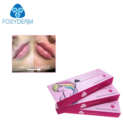 Fosyderm 1 ml Υαλουρονικό οξύ Ενέσεις δερματικού γεμιστήρα για την αύξηση του μεγέθους των χειλιών