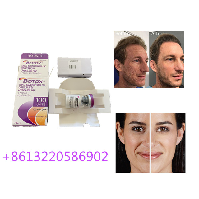Η αντι έγχυση 100units γήρανσης Allergan  δακτυλογραφεί μια αντι ρυτίδα