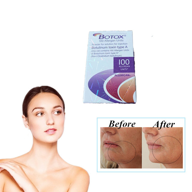 Allergan  100 Units Τύποι Botulinum Toxin Injection κατά των ρυτίδων