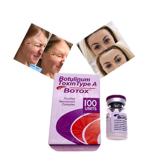 Η Botulinum τοξίνη Allergan δακτυλογραφεί ένα  Hyaluronic οξύ υλικών πληρώσεως 100 μονάδων δερμικό