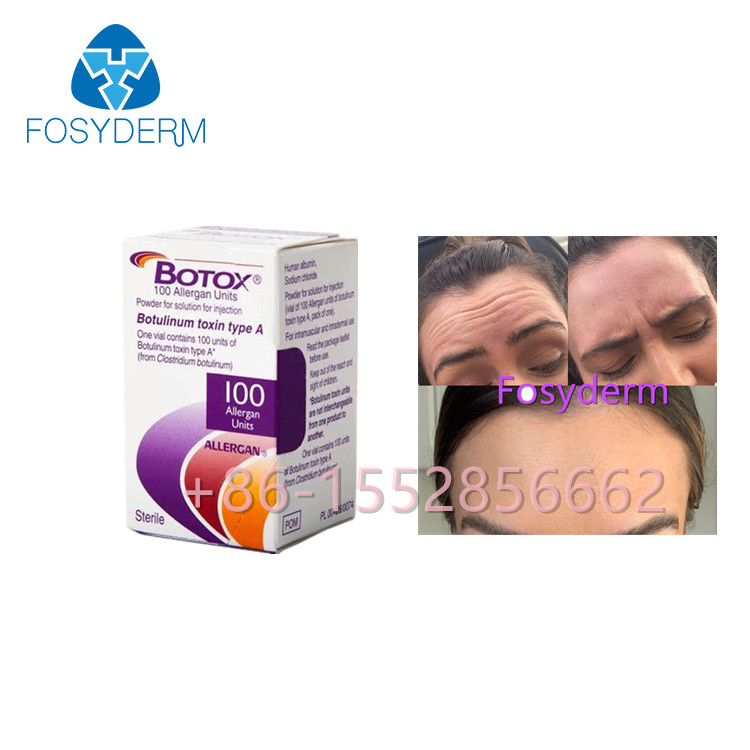 Το Allergan  100 αντι ρυτίδες τοξινών μονάδων Botulinum δακτυλογραφεί μια έγχυση