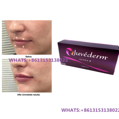 Juvederm Δερμικό Συμπλήρωμα για τα χείλη Juvederm Ultra3 Ultra4 Συμπληρώματα Προγεμισμένη σύριγγα