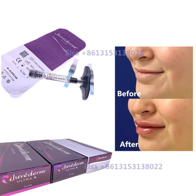 2 × 1 ml Ενέσιμη δερματική σφραγίδα Juvederm Ultra3 Ultra4 Voluma