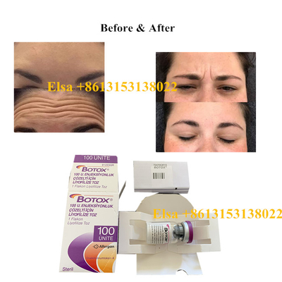 Η Botulinum τοξίνη Allergan εγχύσεων δακτυλογραφεί μια αντι γήρανση 100units