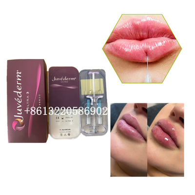 Hyaluronic όξινος δερμικός εγχύσεων 2ml χειλικών υλικών πληρώσεως Juvederm Ultra3
