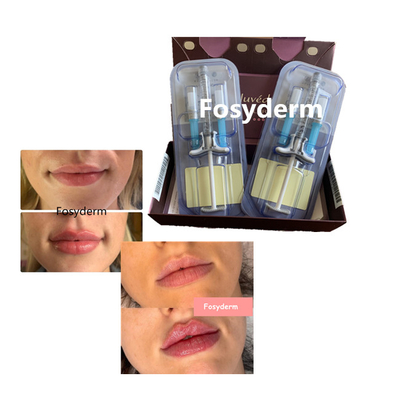 Hyaluronic όξινο χειλικό υλικό πληρώσεως συνδεμένο σταυρός 24mg volbella Juvederm