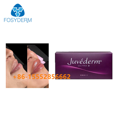 Hyaluronic όξινη έγχυση Juvederm 2ml υλικών πληρώσεως χειλικών αυξήσεων δερμική