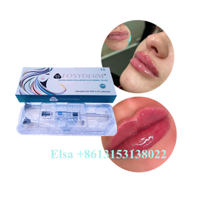 Hyaluronic όξινη γήρανση 1ml 2ml 5ml CE χειλικών υλικών πληρώσεως Juvederm εγχύσεων πηκτωμάτων αντι