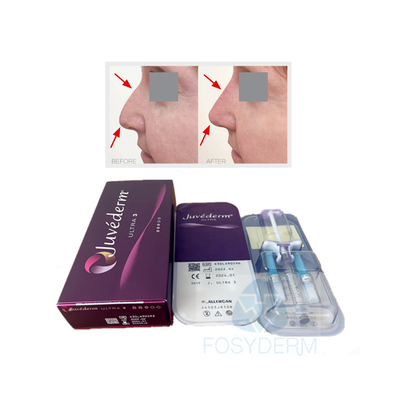 Το χείλι προσώπου διασύνδεσε το δερμικό Hyaluronic όξινο πήκτωμα Juvederm Ultra3 υλικών πληρώσεως