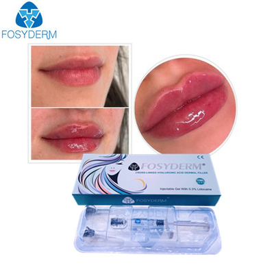 Fosyderm Hyaluronic όξινη πηκτωμάτων αντι του προσώπου έγχυση υλικών πληρώσεως ρυτίδων δερμική