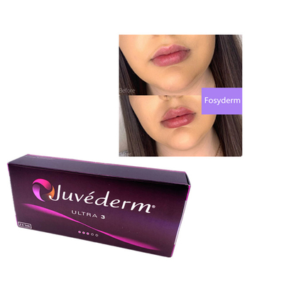 2 ml Juvederm Υαλουρονικό οξύ Δερματικό Συμπλήρωμα Γουρουνιών Συμπλήρωμα Πηγούνι Χείλη Ultra 3