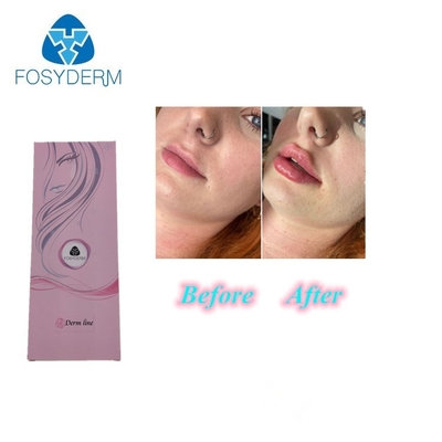1ml 0,3% Hyaluronic όξινη έγχυση χειλικών υλικών πληρώσεως λιδοκαΐνης