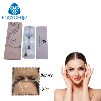 Του προσώπου Hyaluronic όξινη δερμική έγχυση εκταρίου χειλικών ανυψωτών υλικών πληρώσεως