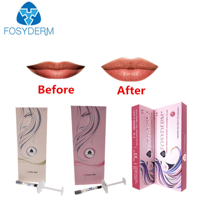 Hyaluronic όξινο εκχύσιμο υλικό πληρώσεως ρυτίδων και χειλιών με τη λιδοκαΐνη