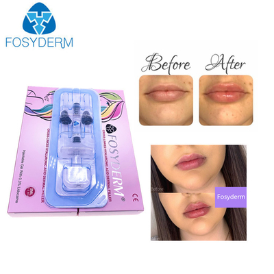 Βαθύ Hyaluronic όξινο Derm εκτάριο CE δερμικό υλικό πληρώσεως πιστοποίησης 1ml για τα χείλια