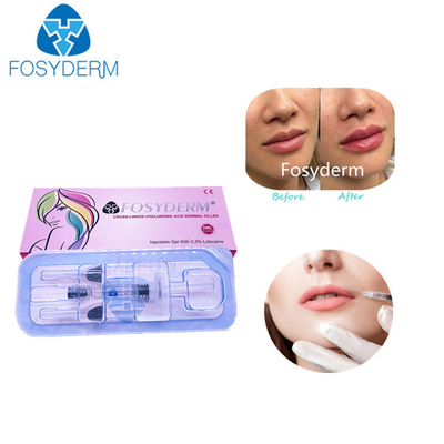 2 όξινες Hyaluronic διαγώνιες συνδεμένες δερμικές εγχύσεις χειλικών υλικών πληρώσεως υλικών πληρώσεως μιλ.