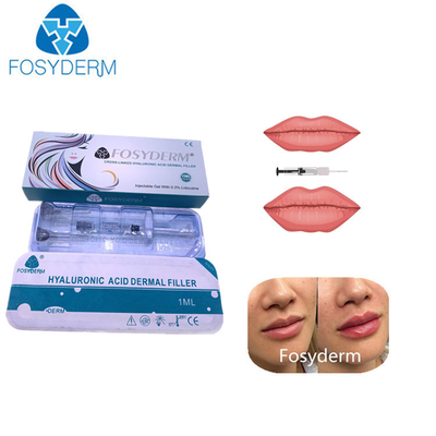 1ml διαγώνιο συνδεμένο Hyaluronic όξινο δερμικό υλικό πληρώσεως για το πηγούνι χειλικής μύτης