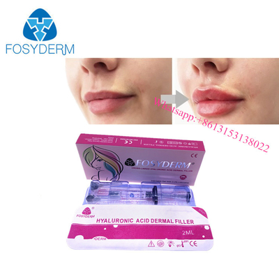 Hyaluronic όξινη δερμική έγχυση πηκτωμάτων υλικών πληρώσεως χειλικής διεύρυνσης cOem