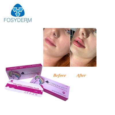 Hyaluronic όξινο δερμικό εκχύσιμο υλικό πληρώσεως για το πρόσωπο μύτης