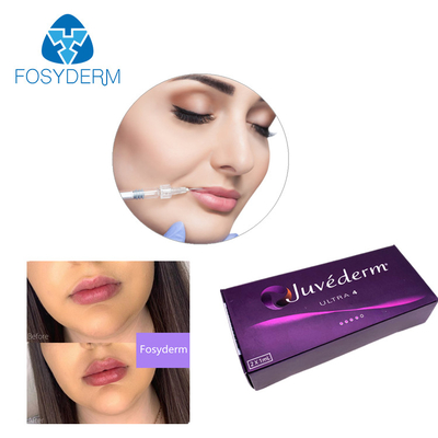 Χειλικό υλικό πληρώσεως 24mg/Ml Juvederm πηκτωμάτων υλικών πληρώσεως Ultra3 Ultra4 Voluma Hyaluronic όξινο δερμικό