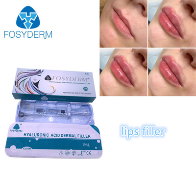 Πλήρωση των Hyaluronic όξινων χειλικών υλικών πληρώσεως 1ml Fosyderm Fosyderm εγχύσεων προσώπου